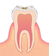 C2歯の内部まで進行したむし歯