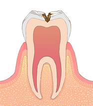 C3神経まで進行したむし歯