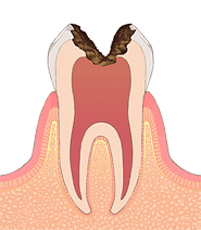 C4歯冠が大きく失われた歯
