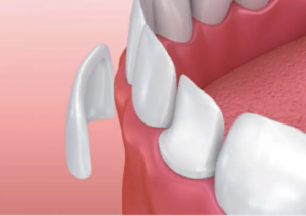 ラミネートべニア